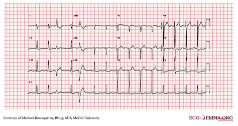 left ventricular hypertrophy abnormal ecg.